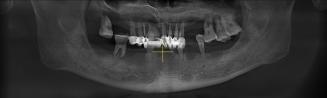 Panoramic image before multiple dental implant surgery