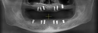 Panoramic image after multiple implant placement, before the final prosthetic restoration